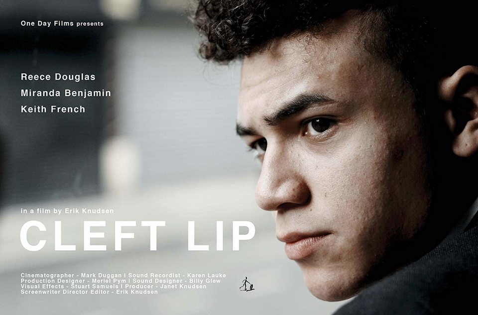 Poster of Cleft Lip - 